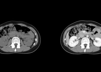Gerybiniai minkštųjų audinių navikai: tipai, simptomai ir gydymas