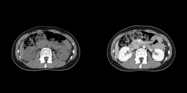Gerybiniai minkštųjų audinių navikai: tipai, simptomai ir gydymas
