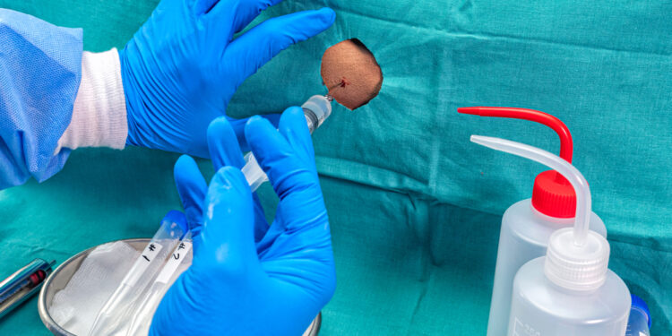 Gyslainės rezginio karcinoma: simptomai, gydymas ir prognozė