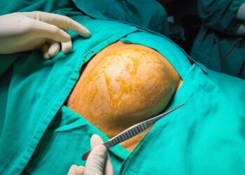 Herpetiforminis dermatitas: celiakinė liga, simptomai ir gydymas