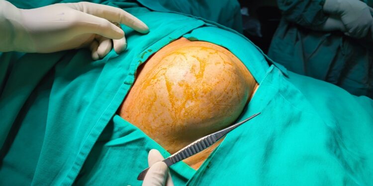 Herpetiforminis dermatitas: celiakinė liga, simptomai ir gydymas