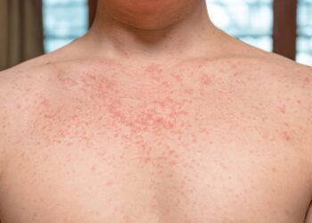 Įgimto raudonukės sindromo (IRS) požymiai, priežastys ir gydymas