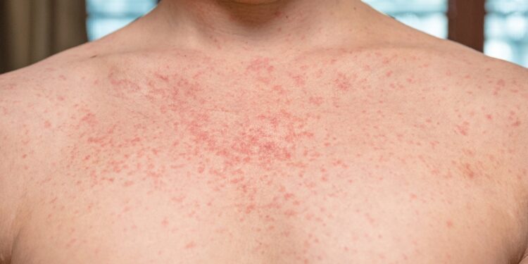 Įgimto raudonukės sindromo (IRS) požymiai, priežastys ir gydymas