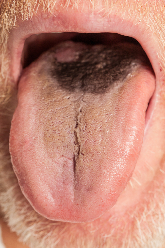 Juodasis plaukuotasis liežuvis: priežastys, kas tai yra ir gydymas