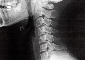 Kaklo kifozė: simptomai, priežastys ir gydymas