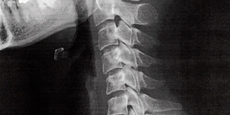 Kaklo kifozė: simptomai, priežastys ir gydymas