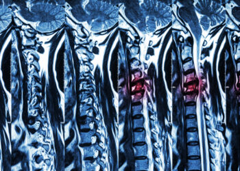 Kaklo mielopatija: kas tai, simptomai ir gydymas