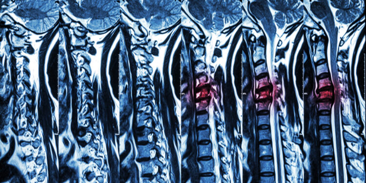 Kaklo mielopatija: kas tai, simptomai ir gydymas