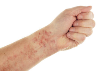 Kapiliarų pralaidumo sindromas: kas tai, priežastys, simptomai ir gydymas