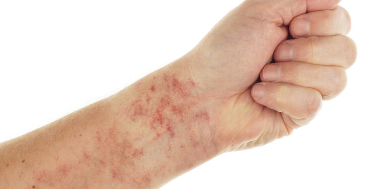 Kapiliarų pralaidumo sindromas: kas tai, priežastys, simptomai ir gydymas