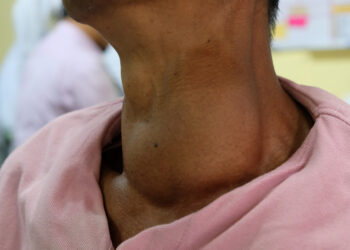 Karcinoidinio sindromo simptomai, priežastys, diagnostika ir gydymas