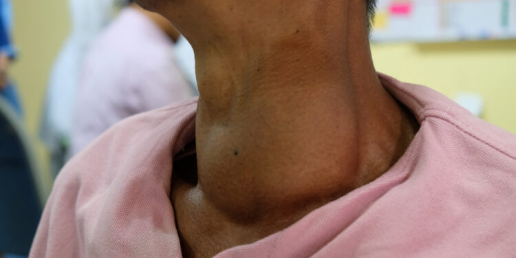 Karcinoidinio sindromo simptomai, priežastys, diagnostika ir gydymas