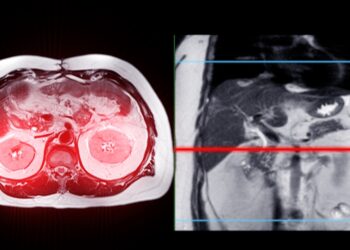 Karcinomatozė (karcinozė): rūšys, apibrėžimas ir simptomai