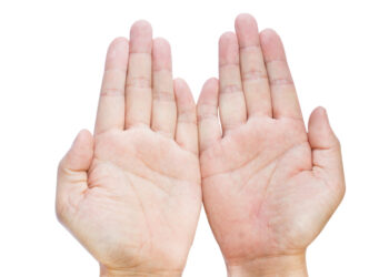 Klinodaktilija: Priežastys ir prognozė