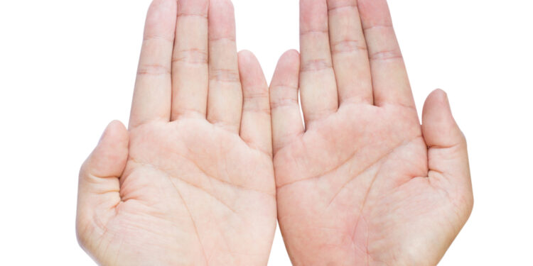 Klinodaktilija: Priežastys ir prognozė