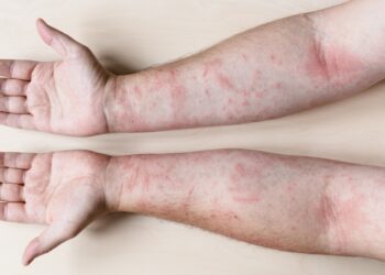 Kontaktinis dermatitas