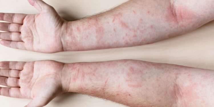 Kontaktinis dermatitas