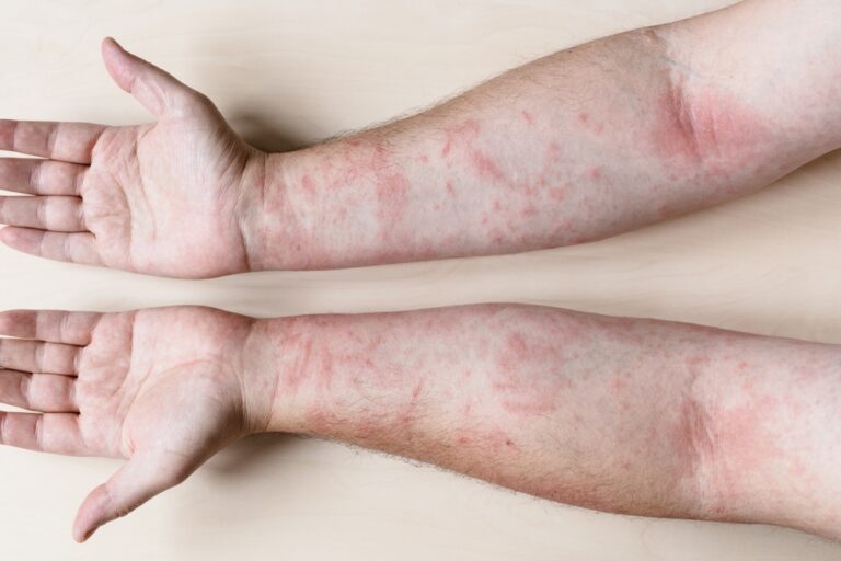 Kontaktinis dermatitas