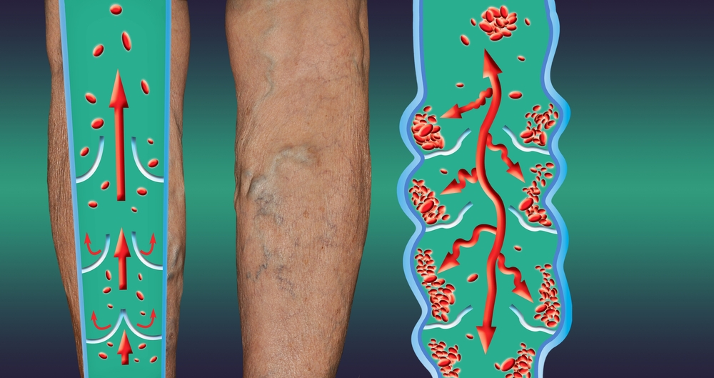 Kraujo krešuliai: kas tai ir kaip jie veikia