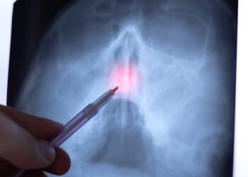 Kreiva nosies pertvara: simptomai ir gydymas