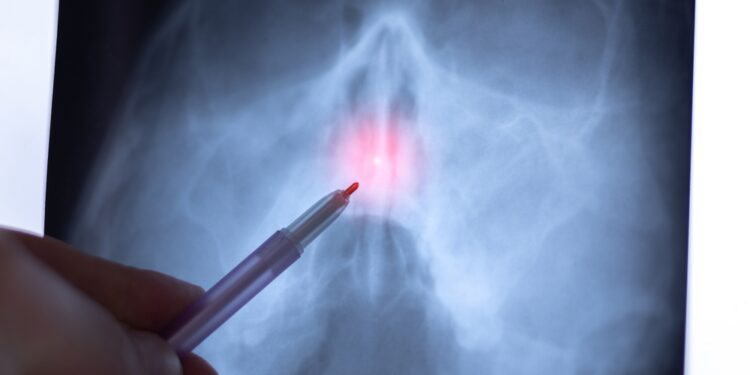 Kreiva nosies pertvara: simptomai ir gydymas