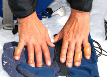 Nušalimas (pernio): kas tai, simptomai, priežastys ir gydymas