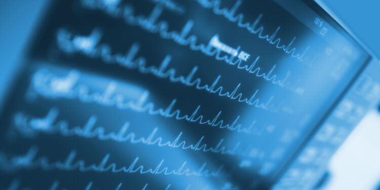 Prieširdžių virpėjimas su greita skilvelių reakcija