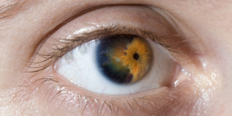 Ragenos distrofija: tipai, simptomai, priežastys ir gydymas