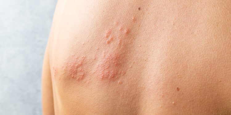 Šaltinė dilgėlinė: kas tai, simptomai, priežastys ir gydymas