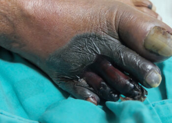 Kritinė galūnių išemija: priežastys, simptomai ir gydymas