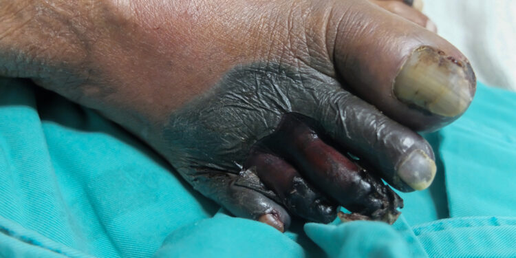 Kritinė galūnių išemija: priežastys, simptomai ir gydymas