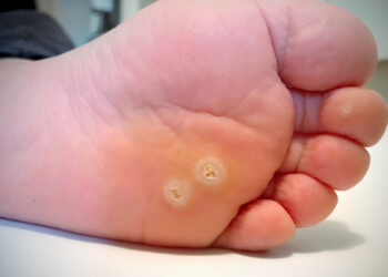 Nuospaudos ir suragėjimai: simptomai, priežastys ir gydymas