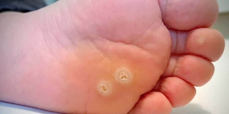 Nuospaudos ir suragėjimai: simptomai, priežastys ir gydymas