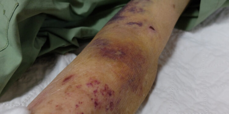 Išplitusi intravaskulinė koaguliacija (DIC): priežastys ir simptomai