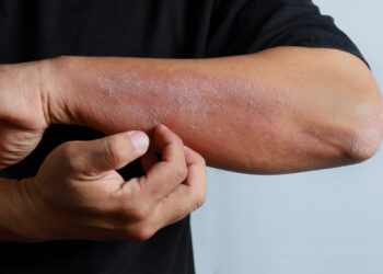 13 būdų sumažinti infekcijų riziką sergantiems MDS