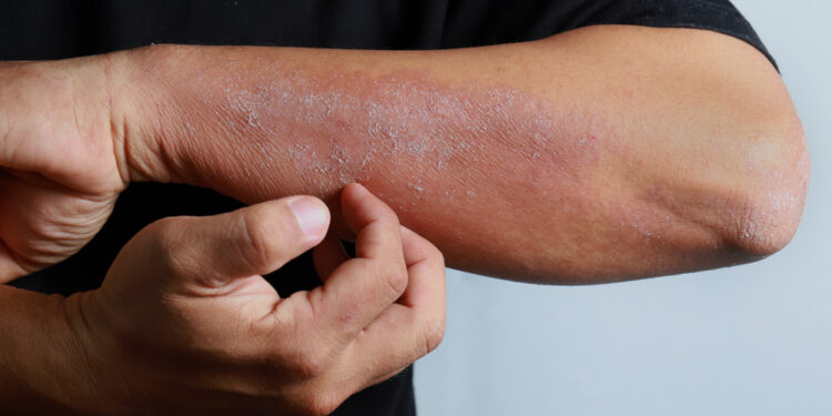 13 būdų sumažinti infekcijų riziką sergantiems MDS