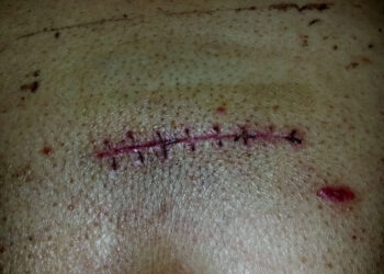 Epidurinis hematomas (EDH): simptomai, priežastys ir gydymas