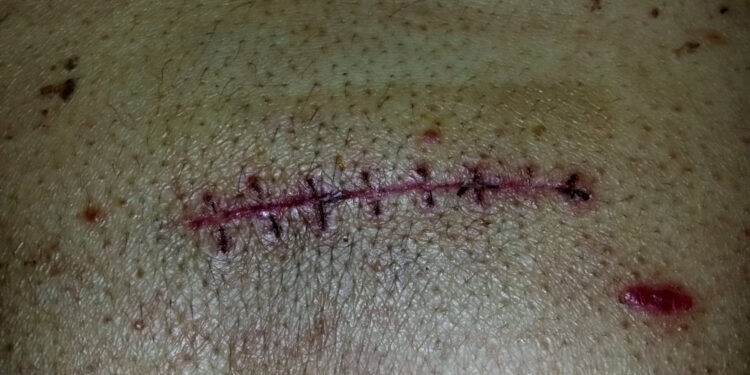 Epidurinis hematomas (EDH): simptomai, priežastys ir gydymas