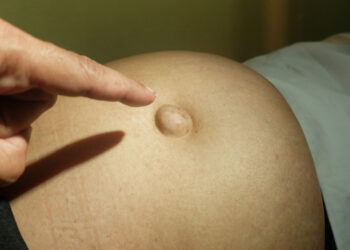 Enterocelė (plonosios žarnos iškritimas): priežastys, simptomai ir gydymas