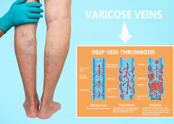 Embolija: Įspėjamieji požymiai ir simptomai