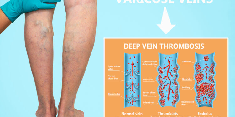 Embolija: Įspėjamieji požymiai ir simptomai
