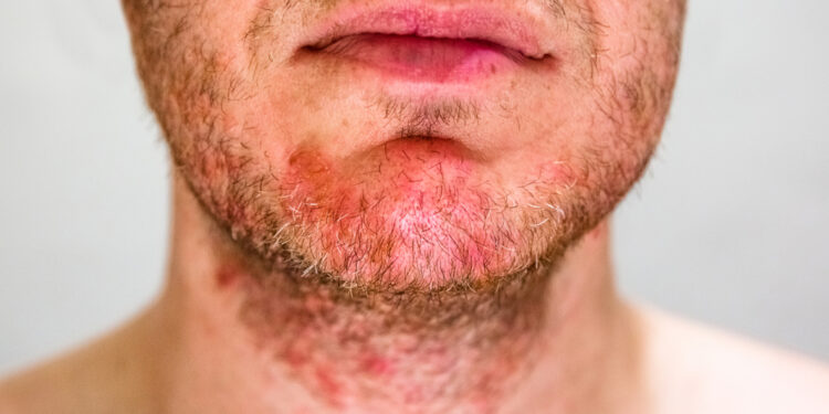 Kūdikių lopšelinės žvynelinės (seborėjinio dermatito) priežastys