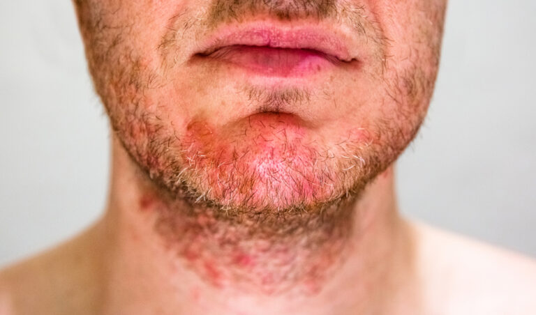 Kūdikių lopšelinės žvynelinės (seborėjinio dermatito) priežastys