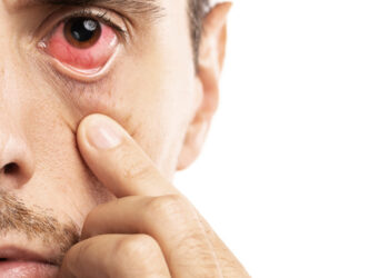 Ektropionas: simptomai, tipai, priežastys ir gydymas