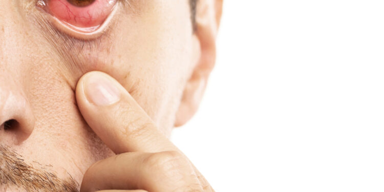 Ektropionas: simptomai, tipai, priežastys ir gydymas