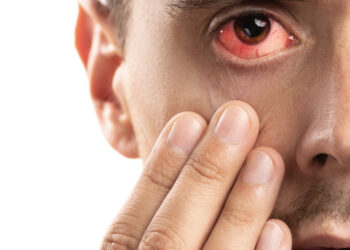 Ūminis ragenos hidroposas: priežastys, simptomai ir gydymas