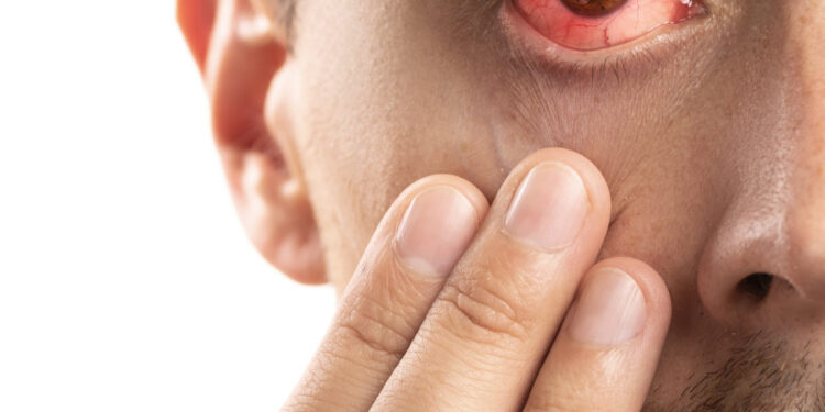 Ūminis ragenos hidroposas: priežastys, simptomai ir gydymas