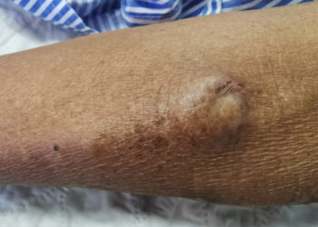 Kietojo dangalo arteriovenozįs fistulė (dAVF): simptomai ir gydymas