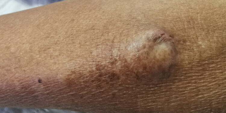 Kietojo dangalo arteriovenozįs fistulė (dAVF): simptomai ir gydymas