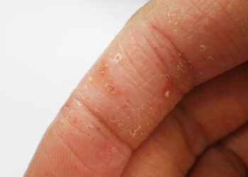 Dishidrotinė egzema (dishidrozė): simptomai, priežastys, gydymas